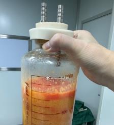 包头水动力吸脂手术要做多久？